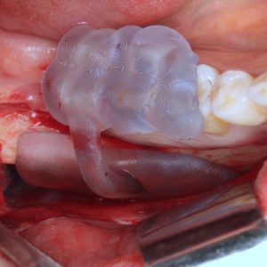 guided bone harvest