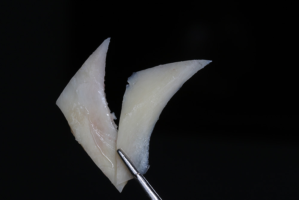 guided-bone-harvesting guided-bone-harvesting