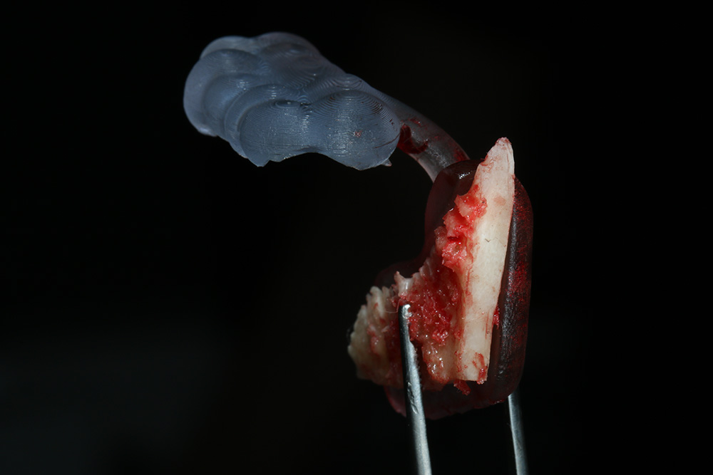 guided-bone-harvesting guided-bone-harvesting